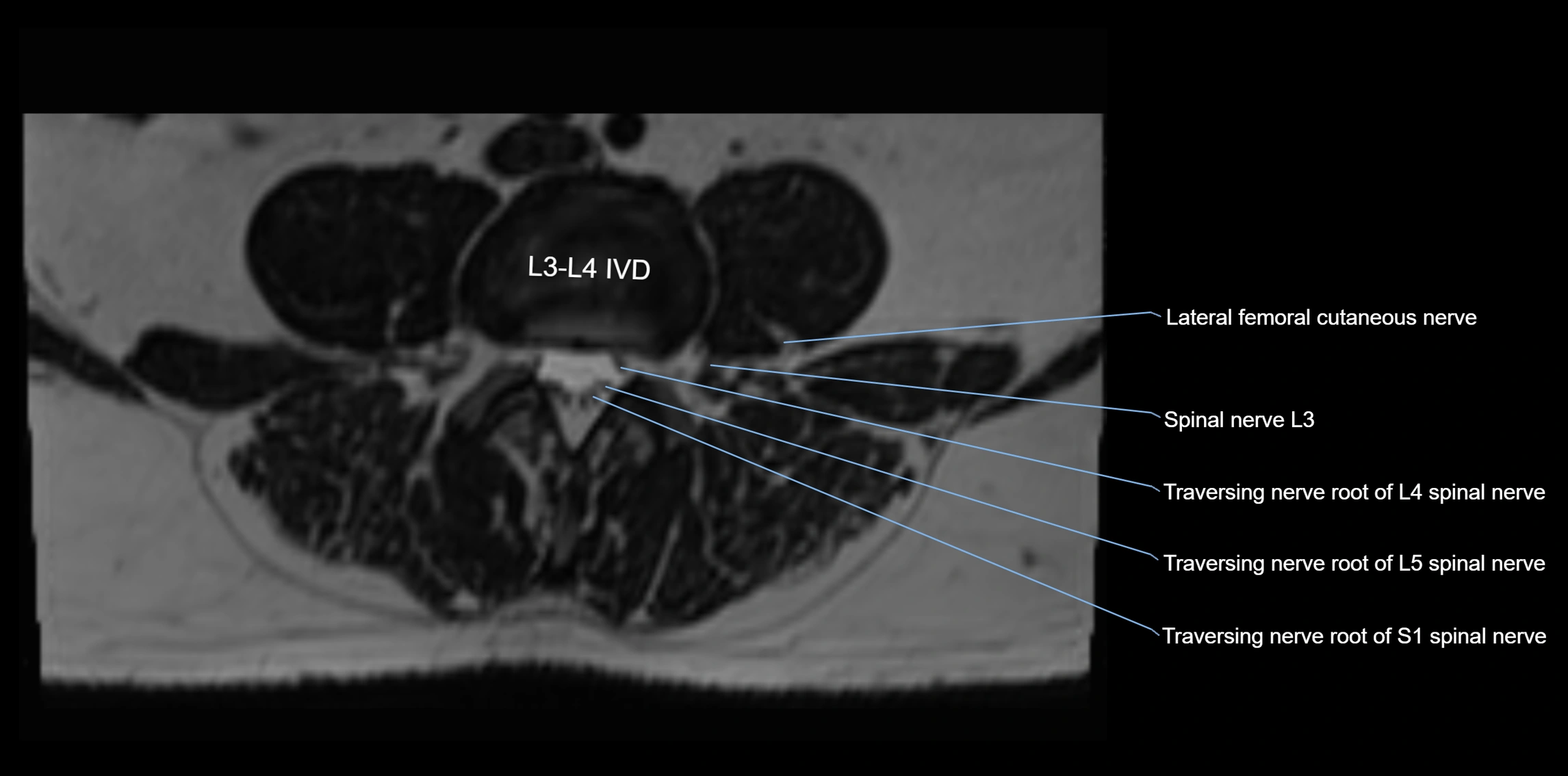 MR lumbosacral plexus axial cross sectional anatomy 3T  radiology  image-img-1008001-00033.webp